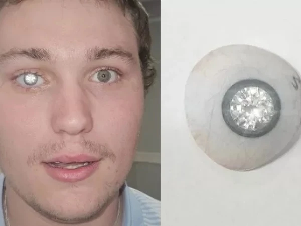 شہری نے بینائی کھودینے کے بعد اپنی آنکھ میں ہیرا لگوا کر سب کو حیران کردیا