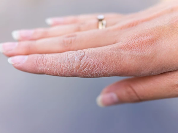 سردیوں میں جلد خشک، سخت اور کُھر دری کیوں ہو جاتی ہے، اس سے بچاؤ کا طریقہ کیا ہے؟