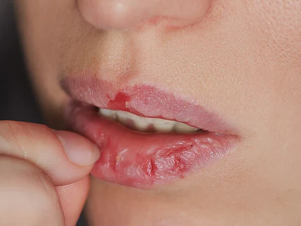 سردیوں میں ہونٹ پھٹنے کی وجہ کیا ہے اور اس کا علاج کیا ہے؟