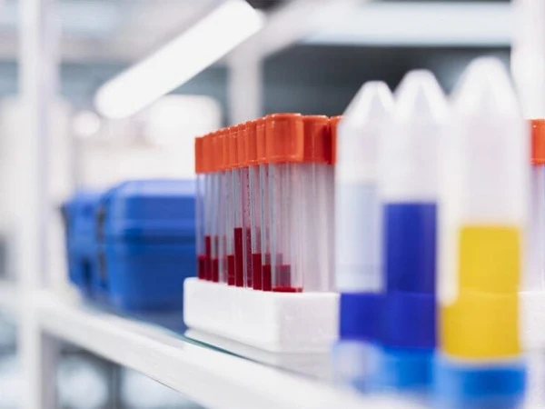 سائنس دانوں نے ٹی بی کے لیے نئی ٹیسٹ ٹیکنالوجی تیار کرلی