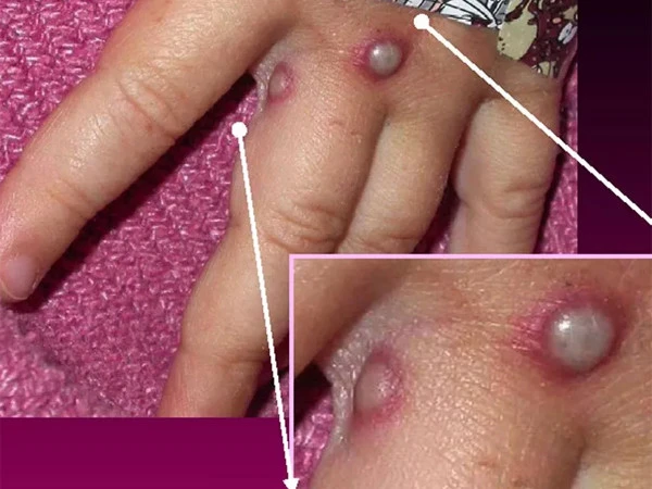 نوزائیدہ بچوں میں ایم پاکس کے کیسز، ماہرین کا انتباہ