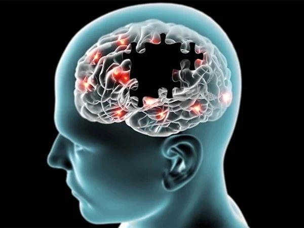 الزائمرز کے خلاف بڑی پیشرفت، نئی دوا نے سائنس دانوں کو پُرامید کر دیا